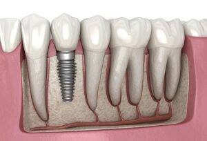 Read more about the article Why Dental Implants Are Better Than Any Other Tooth Replacement in Gurgaon​