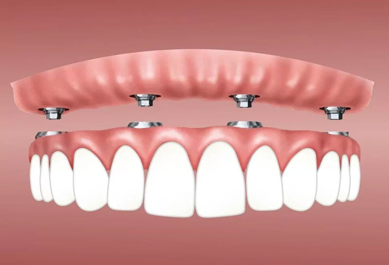 Dental implants for heart patients — safe treatment with cardiologist coordination at Muskaan Dentals Gurgaon