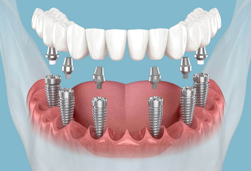 Dental implant risks and complications explained honestly at Muskaan Dentals Gurgaon
