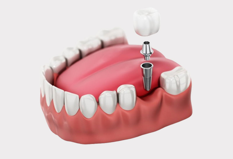 Dental implant brands available at Muskaan Dentals Gurgaon — Straumann Nobel Biocare Osstem Dentium ADIN